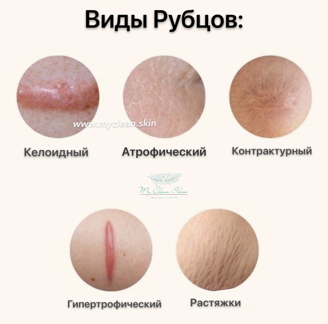 виды рубцов и шрамов, почему и как они появляются