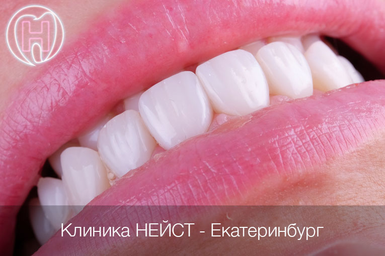 Премиальные композитные виниры в Екатеринбурге, цвет Блич 3