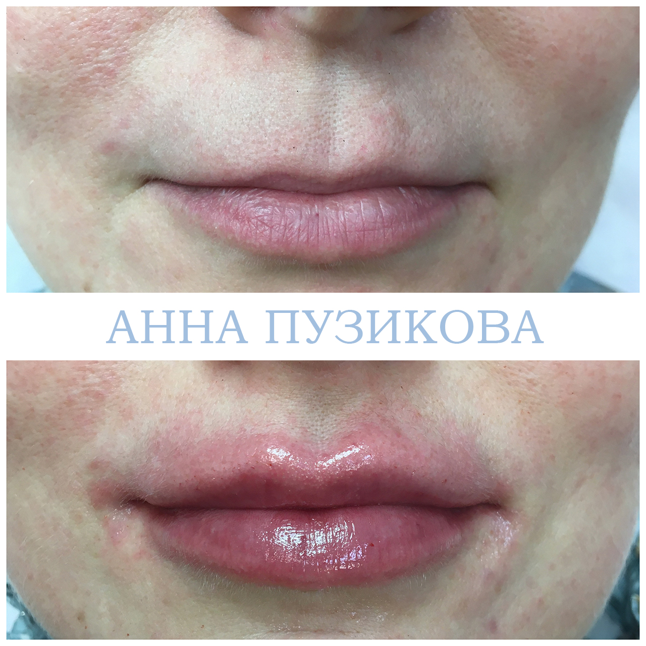 Фото до и после процедуры контурной пластики губ. Естественный результат после коррекции у косметолога Пузиковой Анны Анатольевны, клиника Прадус СПб.