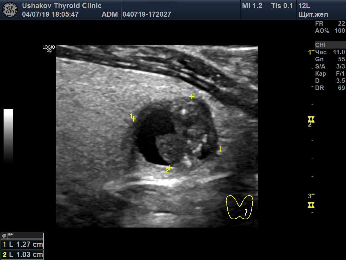 Узел щитовидной железы ti rads 3. Ti-rads2 УЗИ щитовидной. Узел по УЗИ ti rads 2. УЗИ щитовидной железы образование ti_rads 3,4. Ti rads 5.