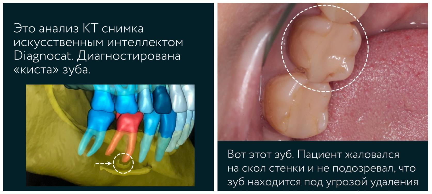 Удаление зуба с кистой на корне