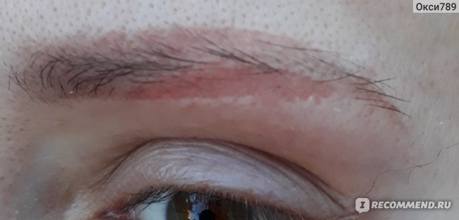 шрам от удаления ремувером, плохое удаление ремувером, некачественное удаление татуажа ремувером