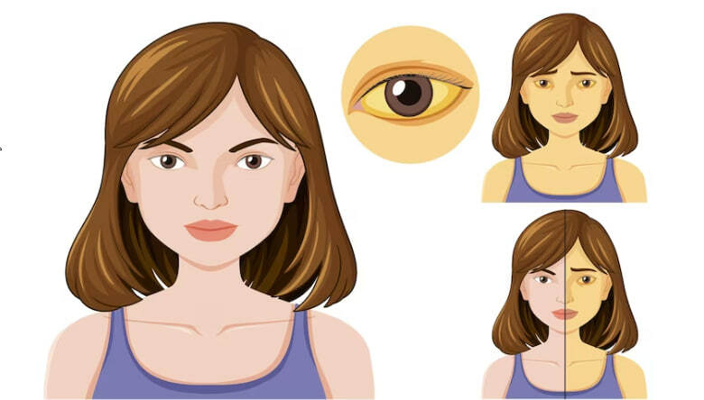 Боли и желтуха при холангите