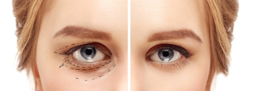 Как ухаживать за глазами после блефаропластики