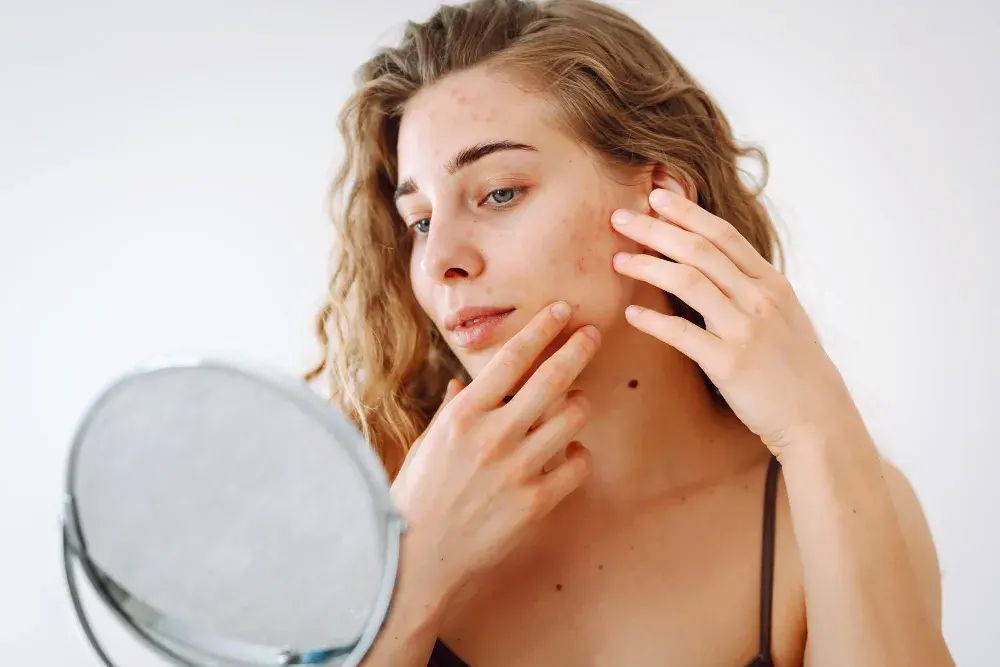 Подросток рассматривает воспалённую кожу лица в зеркало — символ акне, усугубляемого высокими уровнями сахара и инсулина.