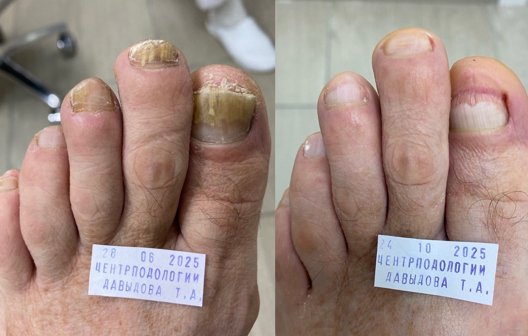 Процесс лечения грибка ногтя. Слева ноготь до лечения, справа в процессе лечения.