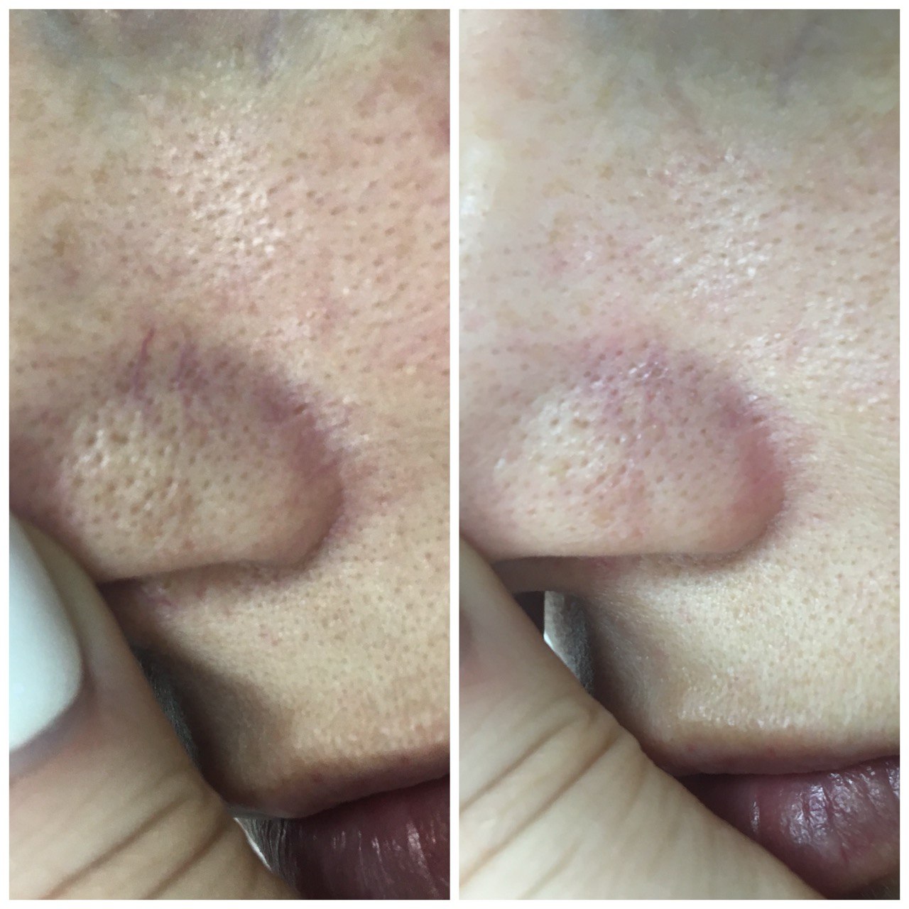 Фото до и после: удаление сосудов лазером в клинике PradusCOSMO, Санкт-Петербург. Безопасно, эффективно и без повреждений кожи