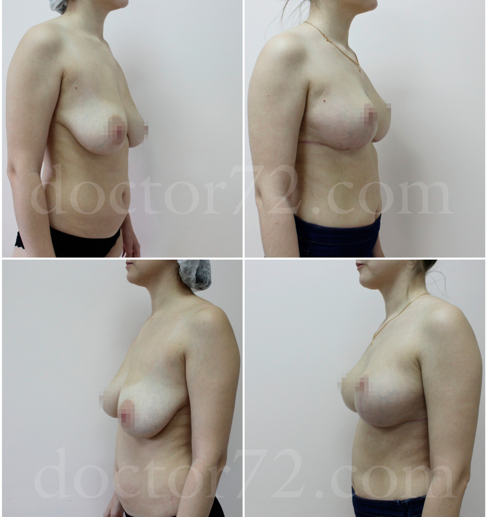 голая грудь после родов фото до и после фото 41