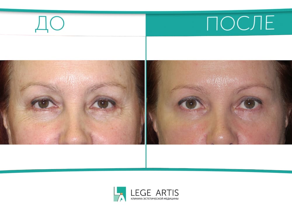 полеткин михаил владимирович тверь блефаропластика. филипп выступец пластический хирург. блефаропластика и эндоскопическая подтяжка лба. ася бежаева пластический хирург махачкала. пластический хирург попал в 17 век 3.