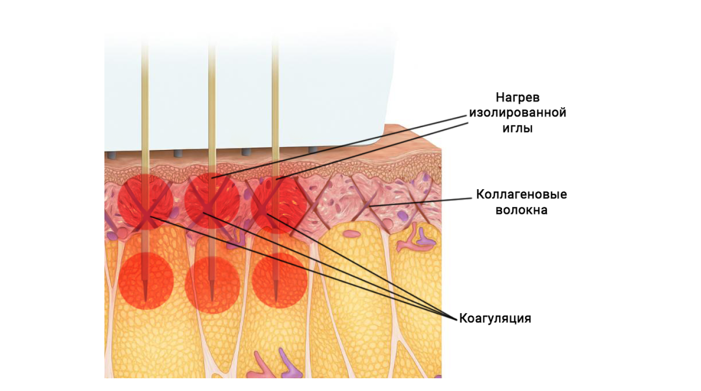 как работает rf лифтинг morpheus 8 принцип действия