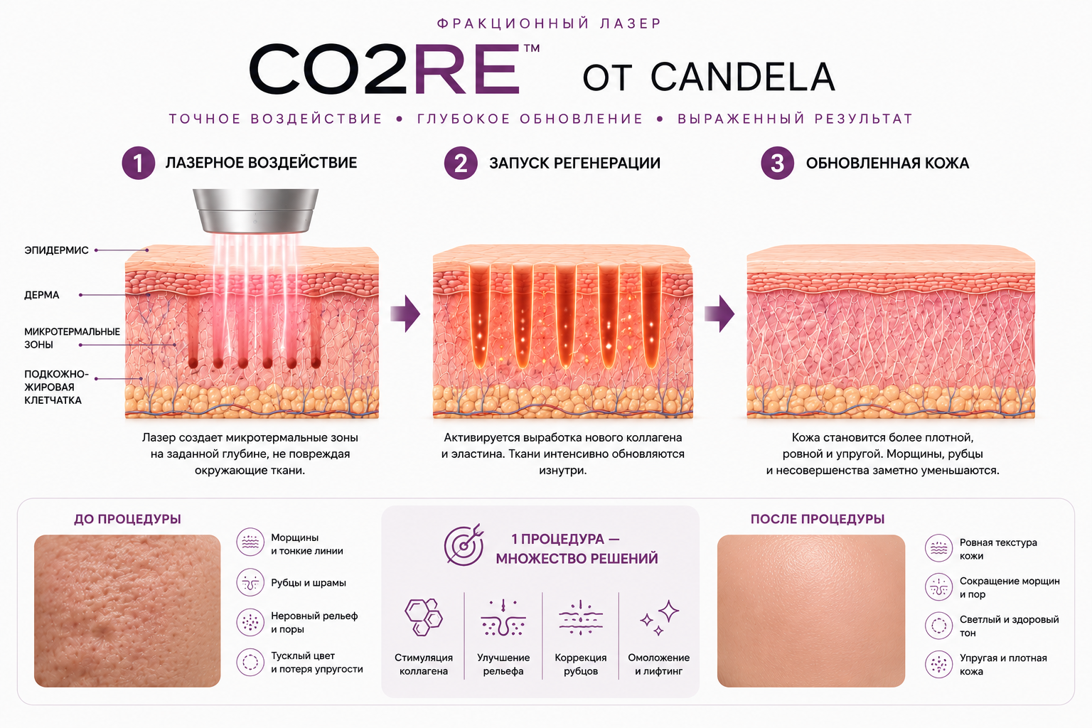 Candela CO2RE: схема фракционного CO2 воздействия